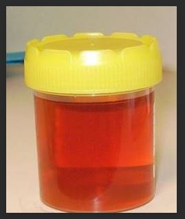HEMOGLOBINIURIA.JPG
